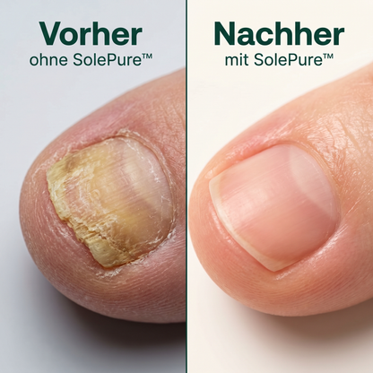 SolePure Nagelpilz Pflaster - Vorher Nachher Vergleich: verfärbter Nagel vorher, gesunder Nagel nachher